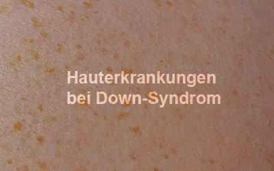 Hauterkrankungen bei Down-Syndrom – Infoabend in Münster